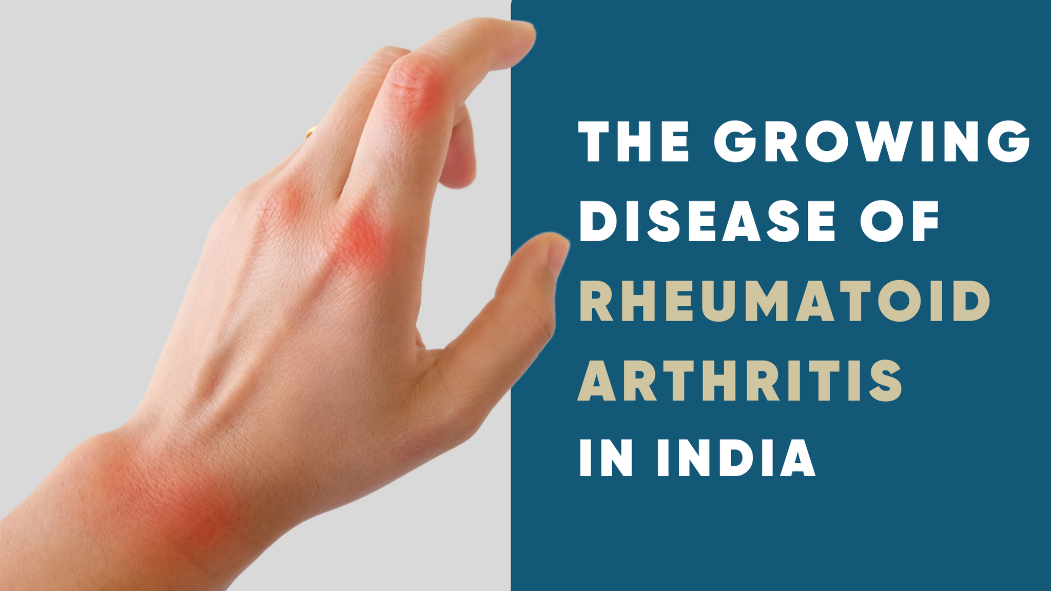 <p><b>THE GROWING DISEASE OF RHEUMATOID ARTHRITIS IN INDIA</b></p> <p> </p>
